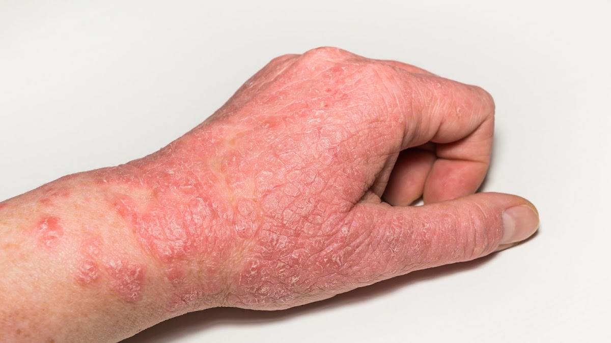 DERMACNÉ - Dra. Gloria Rosales | Clínica Dermatológica Monterrey — foto 4