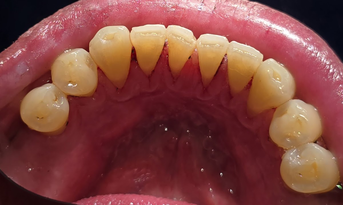 Cirujano Dentista Arturo Lara Endodoncia (Control del Dolor) Lindavista