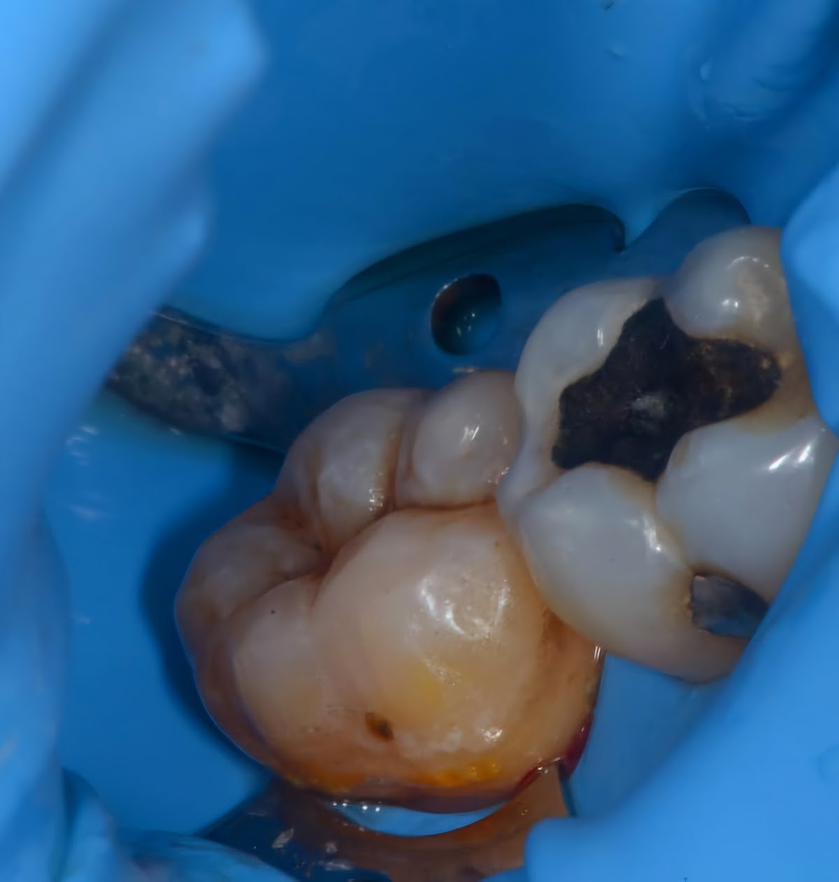 Cirujano Dentista Arturo Lara Endodoncia (Control del Dolor) Lindavista — foto 2