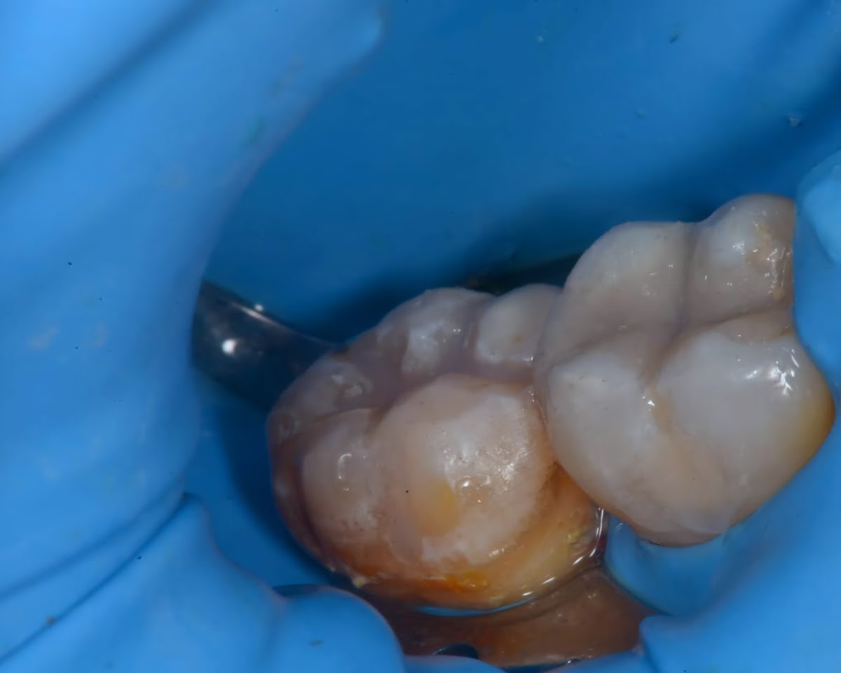 Cirujano Dentista Arturo Lara Endodoncia (Control del Dolor) Lindavista — foto 4