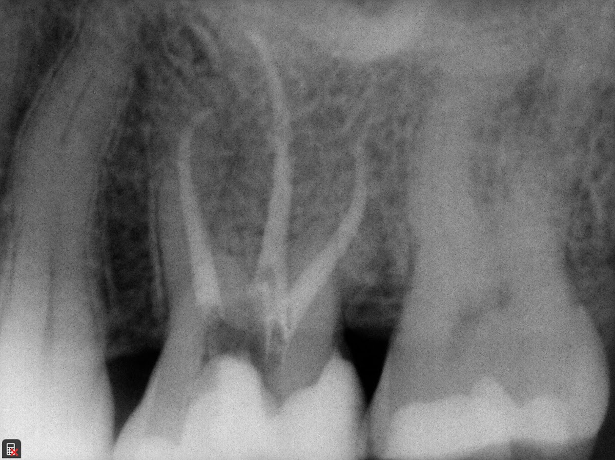 Dr. Héctor Aguiñiga - Endodoncia, root canal tijuana — foto 2