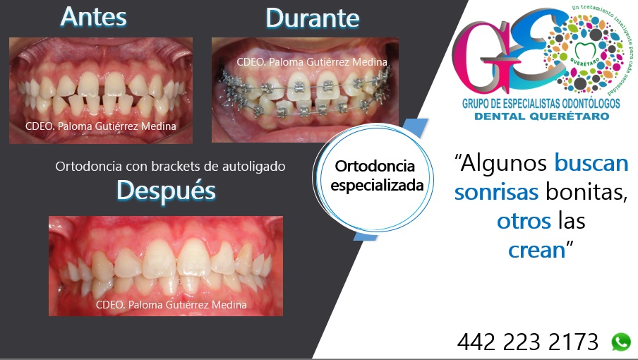 GEO Dental Querétaro - Ortodoncia, Endodoncia, Rehabilitación o Prótesis dental, Otras zonas