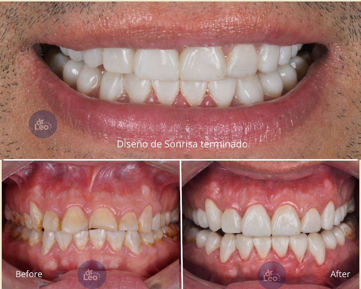 Dr. Leo I Carillas, Diseño de Sonrisa y Rehabilitacion Oral