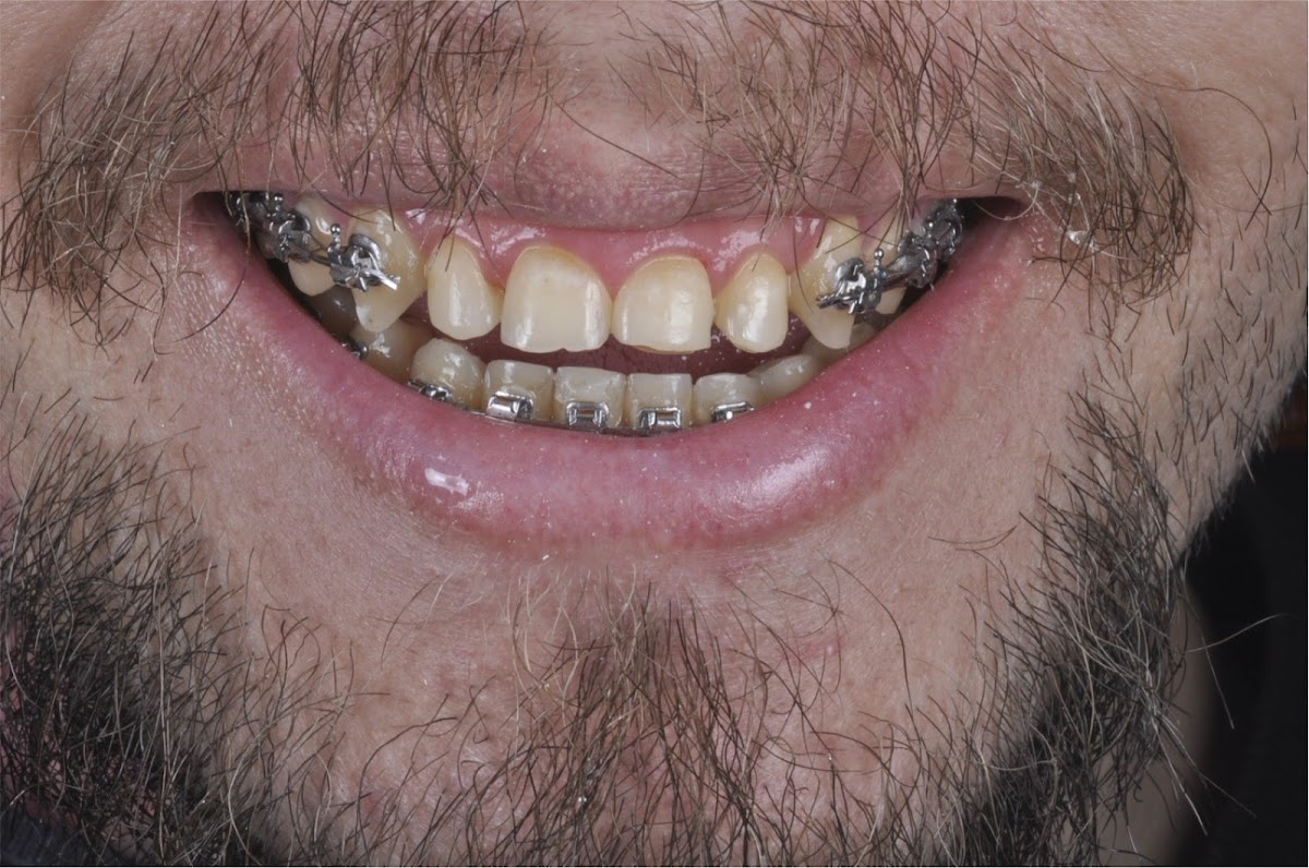 Dr. Leo I Carillas, Diseño de Sonrisa y Rehabilitacion Oral — foto 4