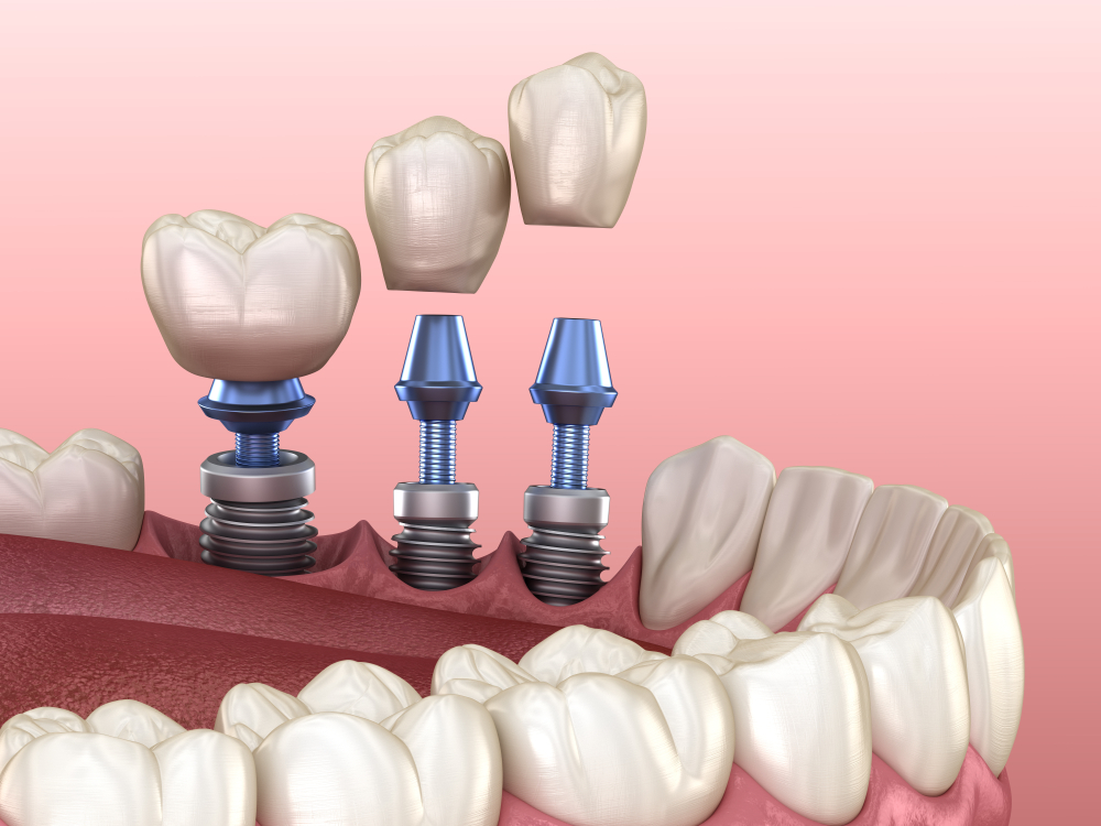 Arte Odontológico Implantes León — foto 2
