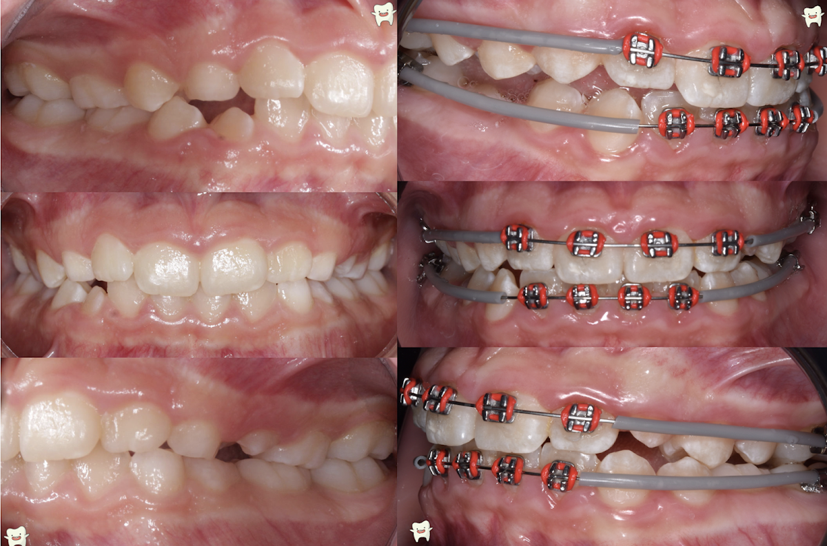 Ortodoncia y Ortopedia Maxilar. Odontología general. Dr André Blanco Villegas — foto 2