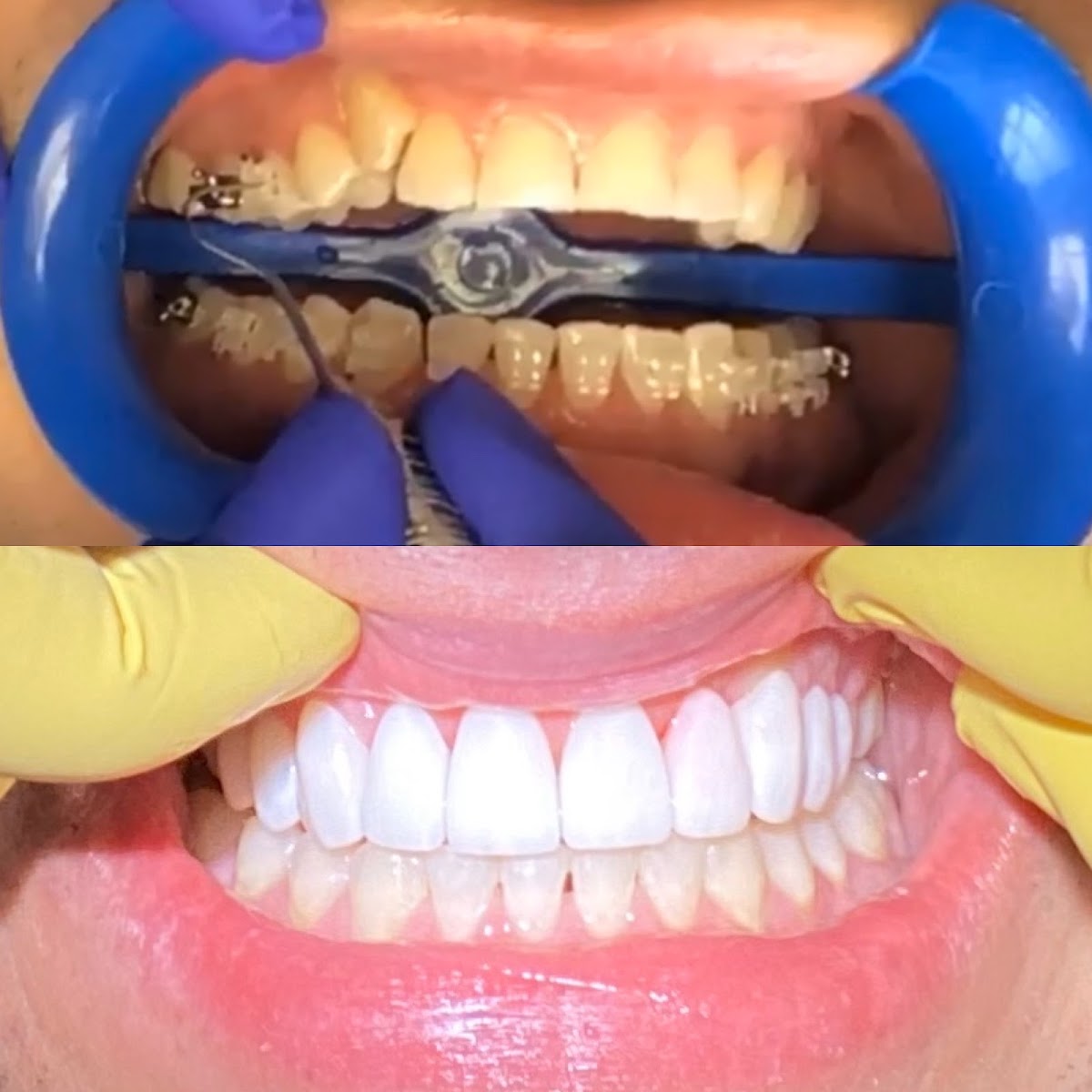KORABE | Dr. Benavides - Carillas Dentales de Porcelana & Dentistas Estéticos en San Pedro Garza García — foto 2