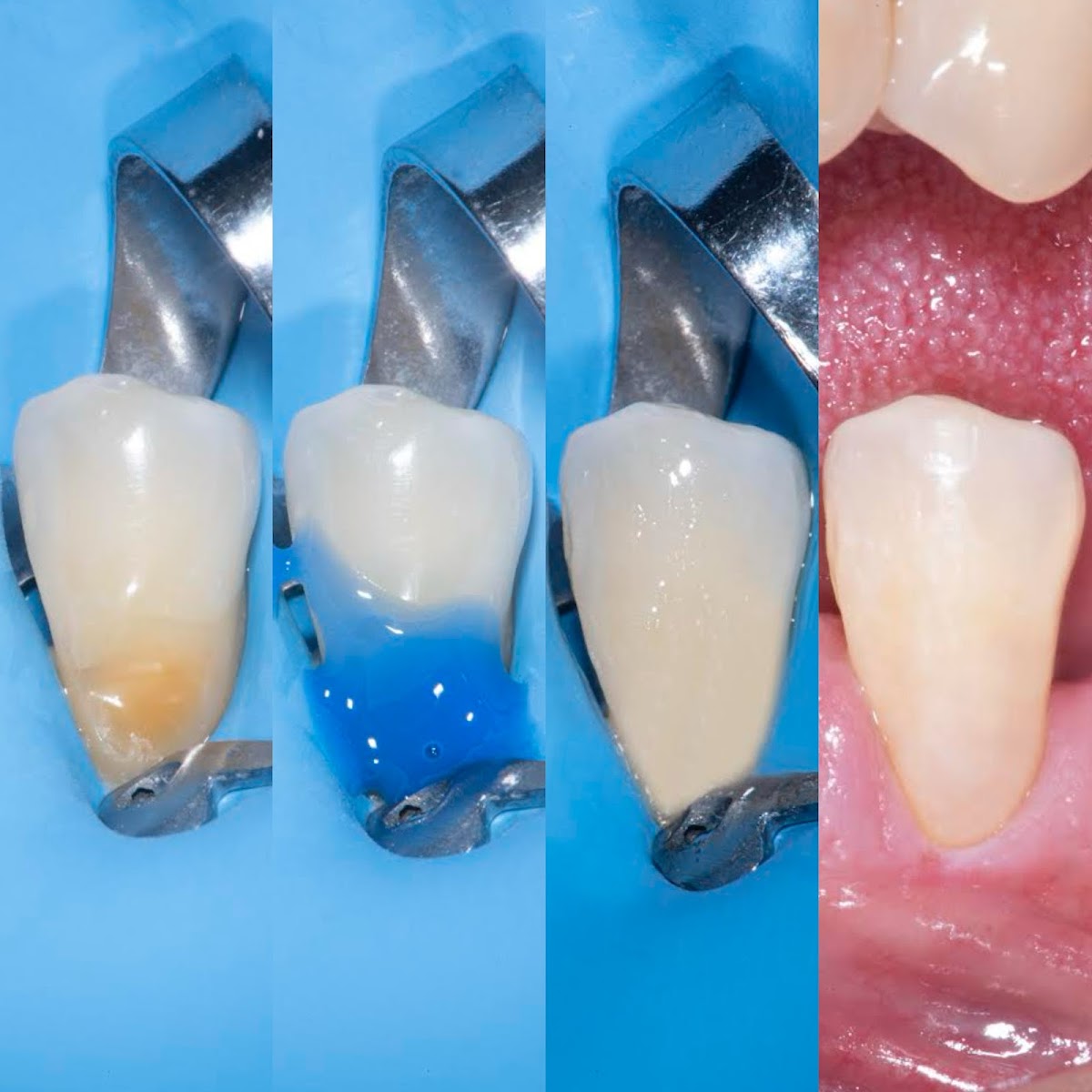 Dental Corona — foto 3