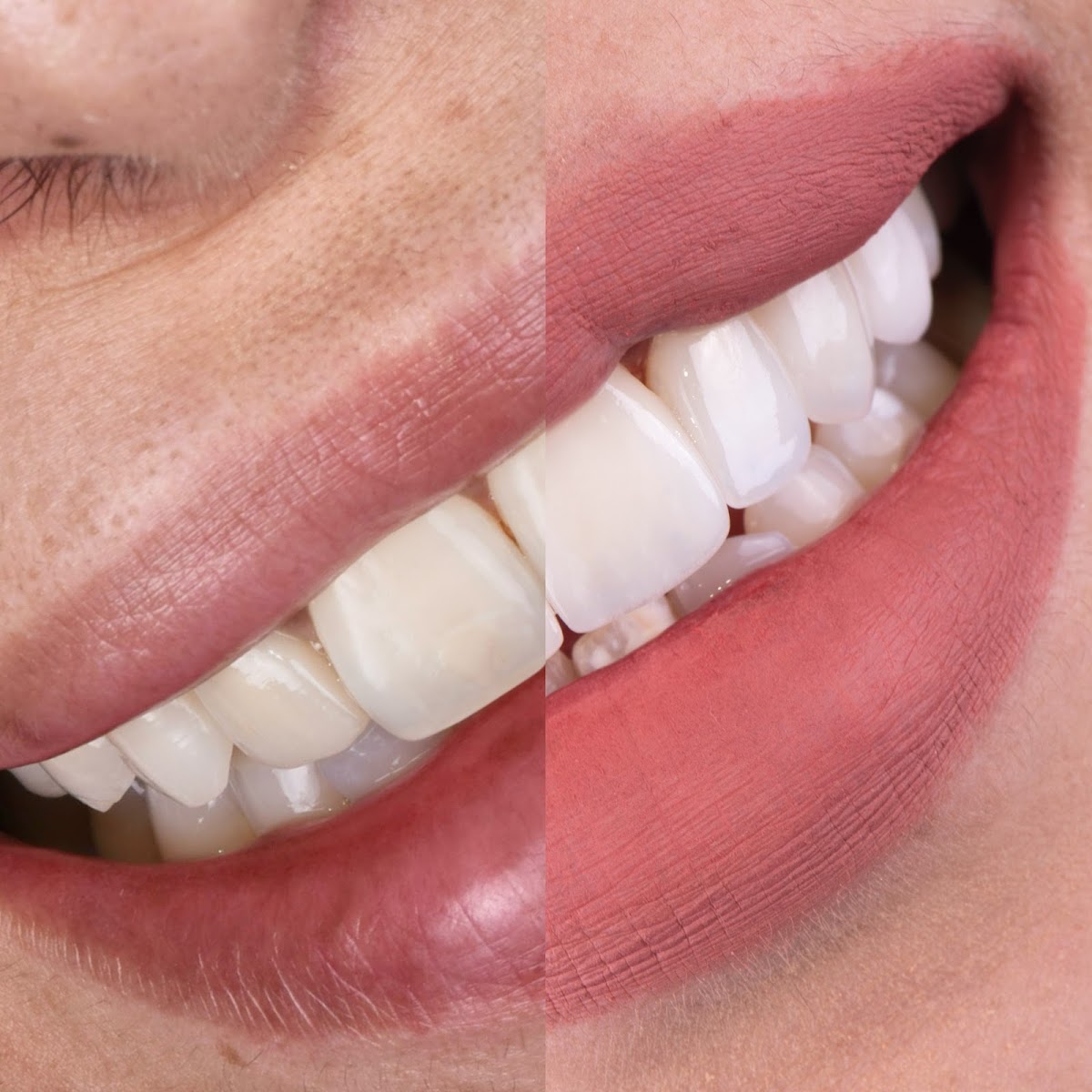 Dental Corona — foto 4