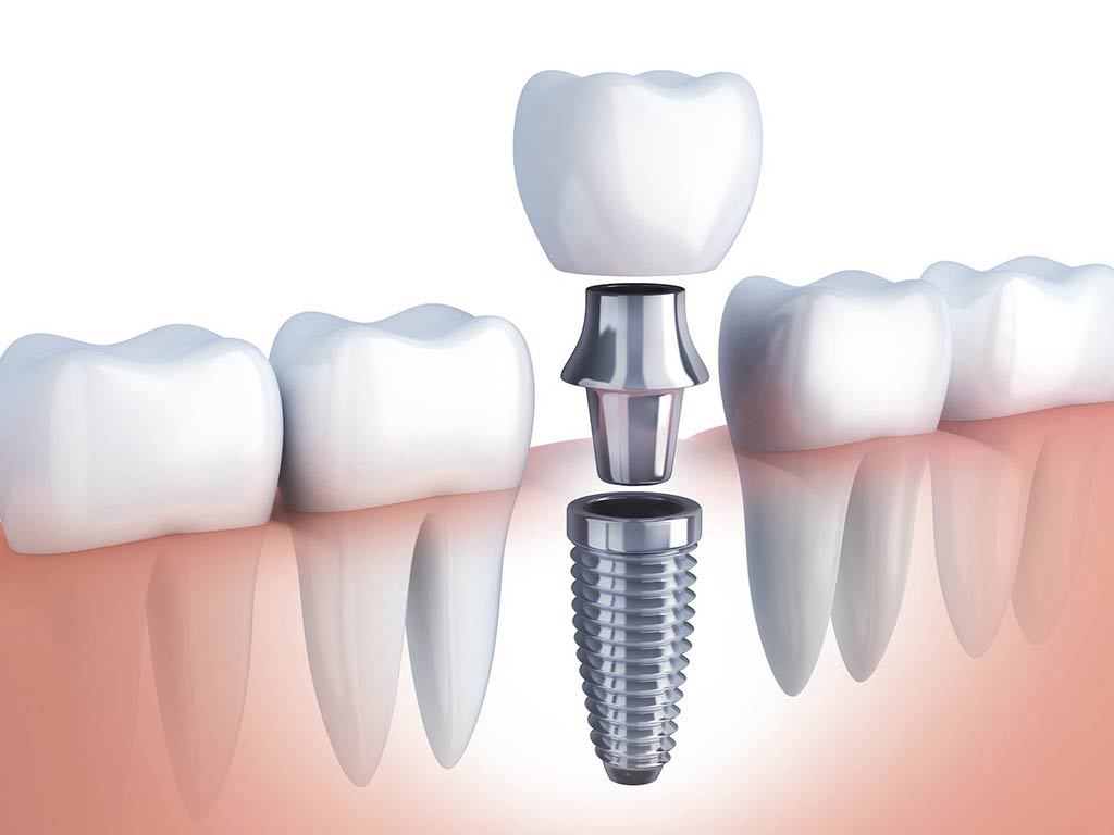 DENTISTA URGENCIAS DENTALES 24 HORAS CLINICA REALDENT CONDESA — foto 3