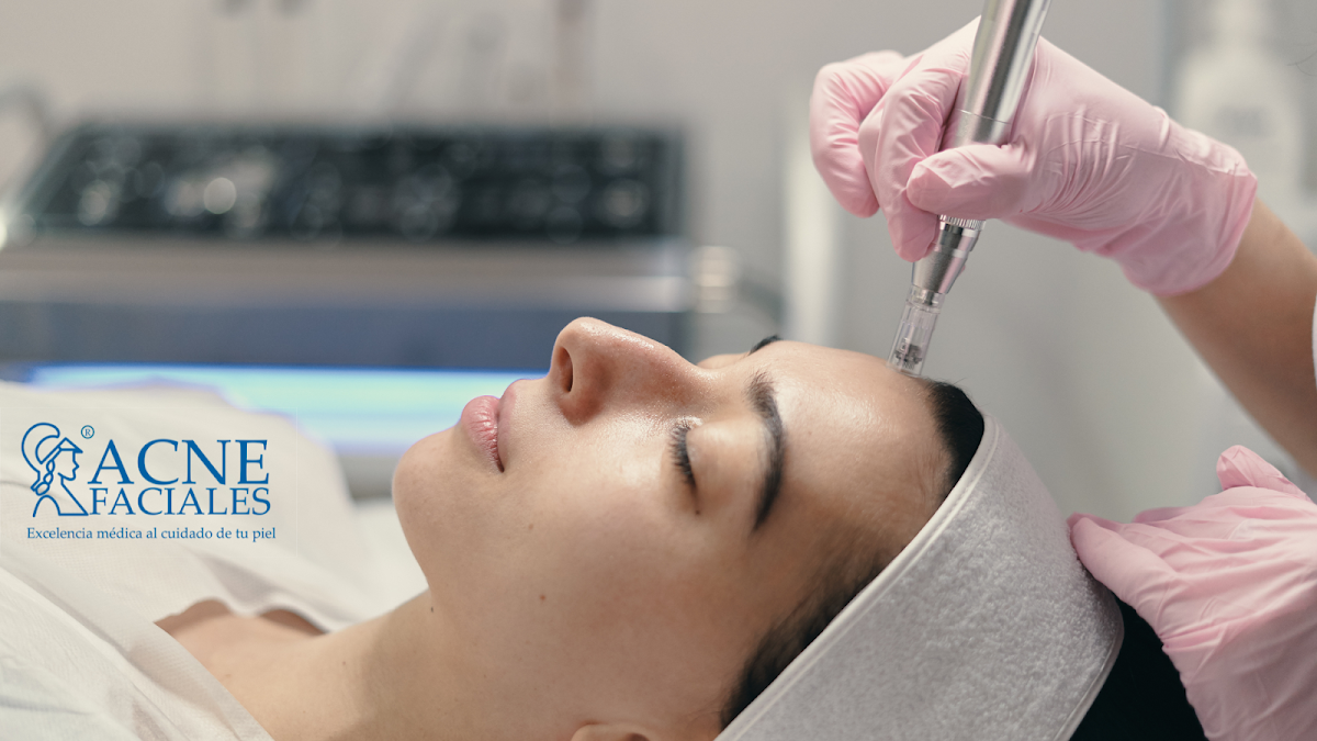 Acne Faciales - Roma Norte