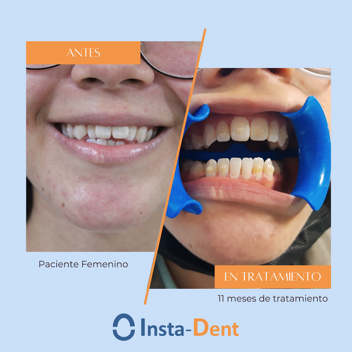ALINEADORES INVISIBLES INSTA-DENT — foto 3