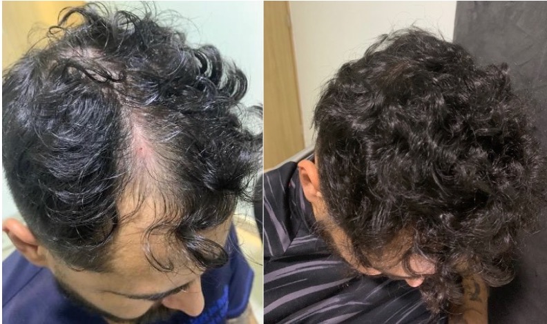 Tricologo Dr. Jorge Cambron - Injerto de Cabello, barba y ceja