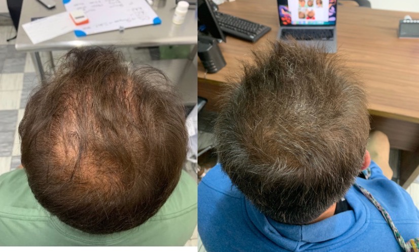 Tricologo Dr. Jorge Cambron - Injerto de Cabello, barba y ceja — foto 2