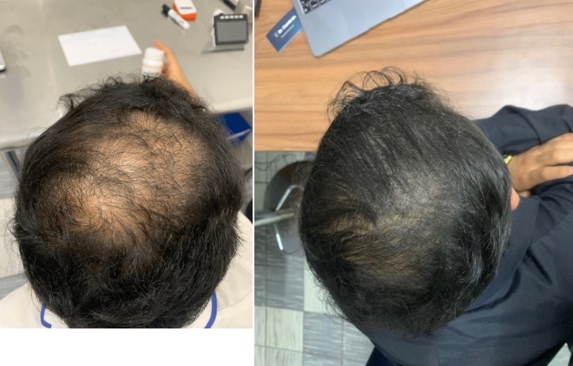 Tricologo Dr. Jorge Cambron - Injerto de Cabello, barba y ceja — foto 3