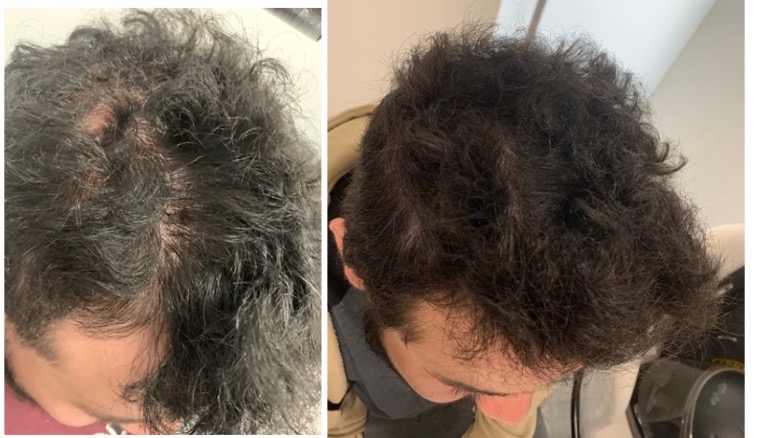 Tricologo Dr. Jorge Cambron - Injerto de Cabello, barba y ceja — foto 4