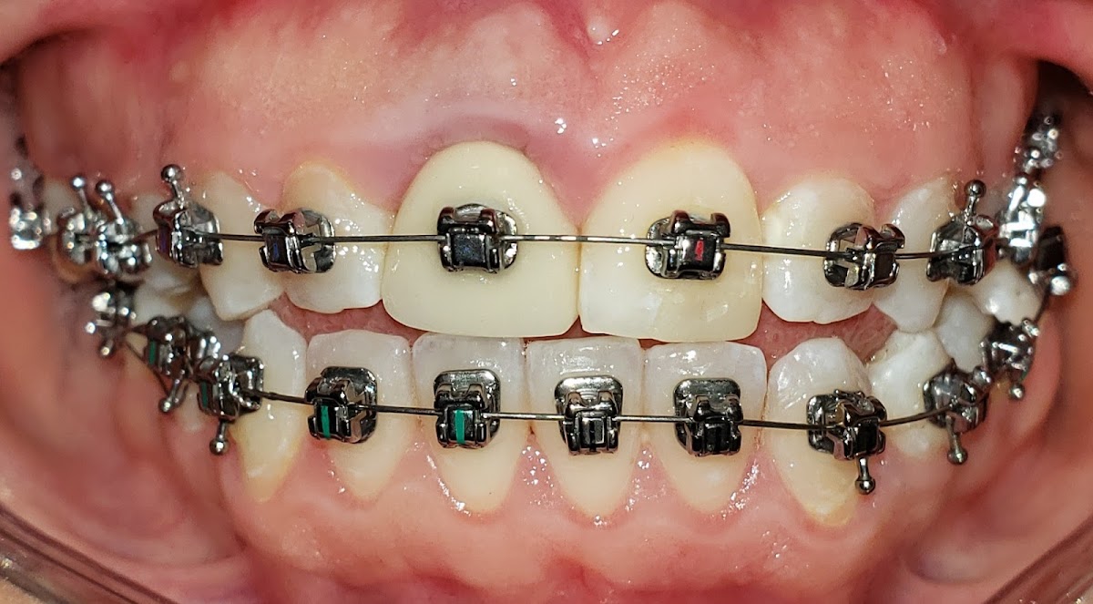 Dra Lorenza Zuluaga Ortodoncia invisible sin brackets y con brackets. — foto 2