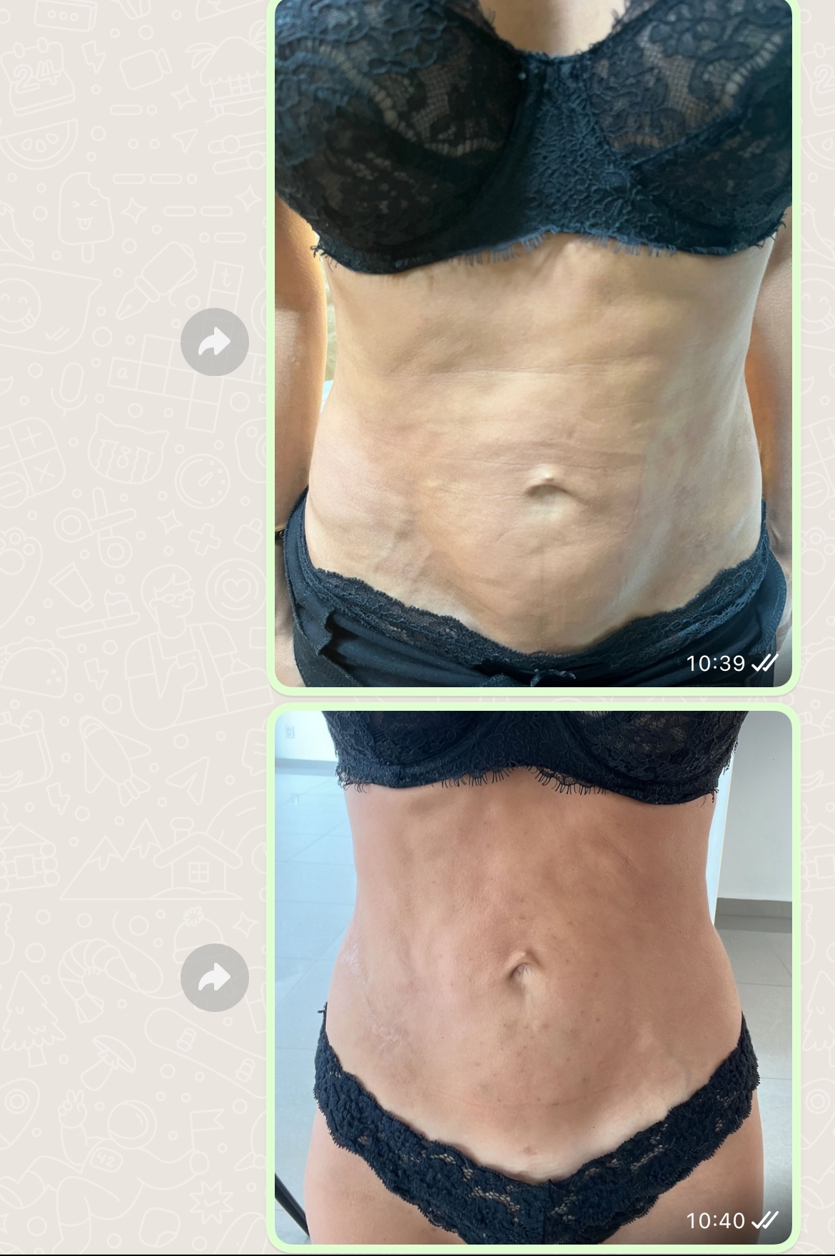 Regenerativa. Desvanecer Estrías. Fibrosis post Liposucción