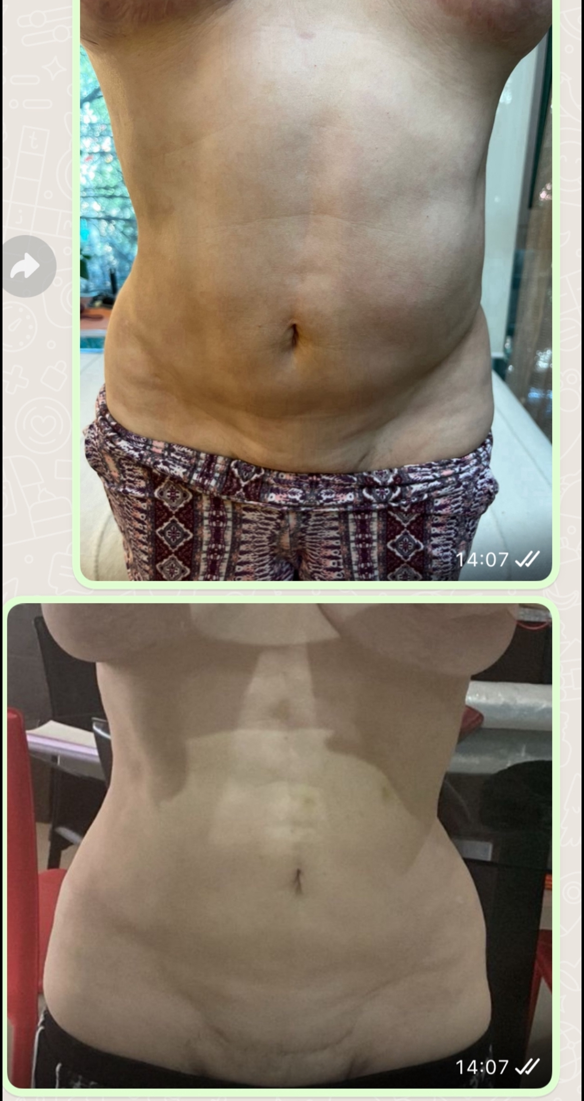 Regenerativa. Desvanecer Estrías. Fibrosis post Liposucción — foto 2