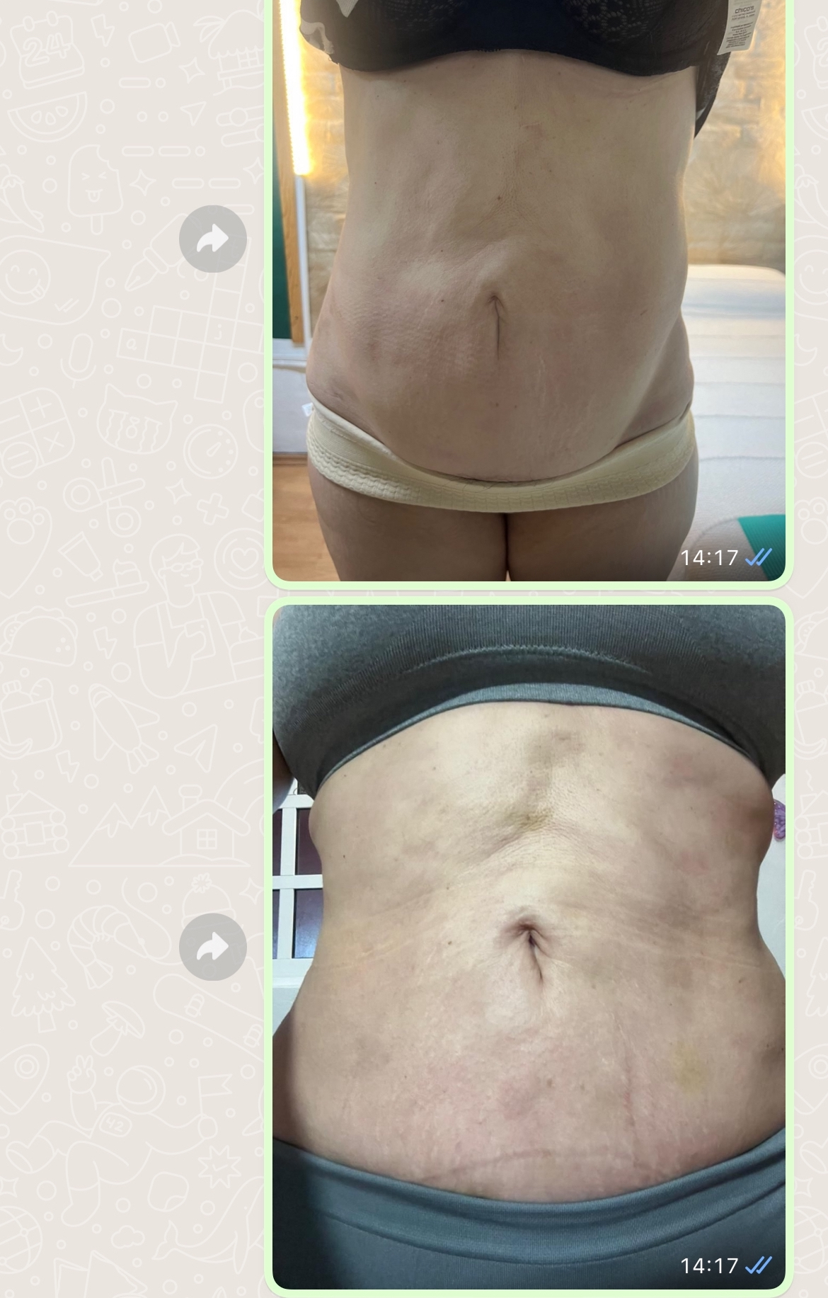 Regenerativa. Desvanecer Estrías. Fibrosis post Liposucción — foto 3