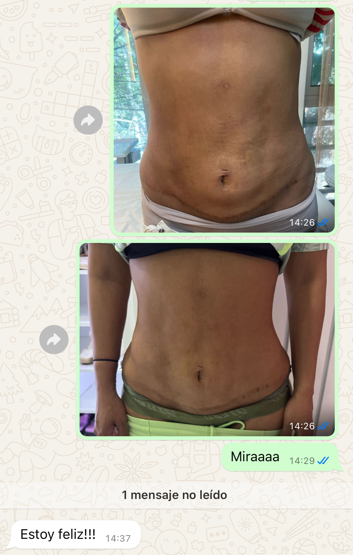 Regenerativa. Desvanecer Estrías. Fibrosis post Liposucción — foto 4