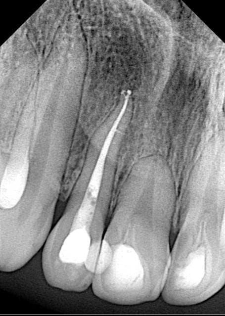 DENTAL ROOTS
