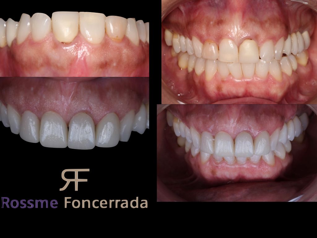 Rehabilitacion oral